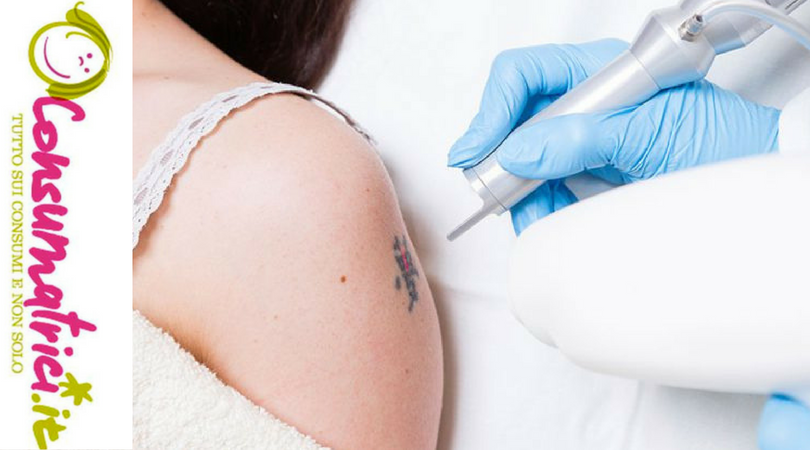Il trattamento laser per la rimozione del tatuaggio in sicurezza