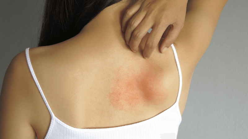 allergie da contatto cause test epicutanei dermoclinico dermatologo milano